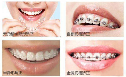 窝沟封闭是跟补牙一样吗,窝沟封闭以后饮食注意事项(图1)